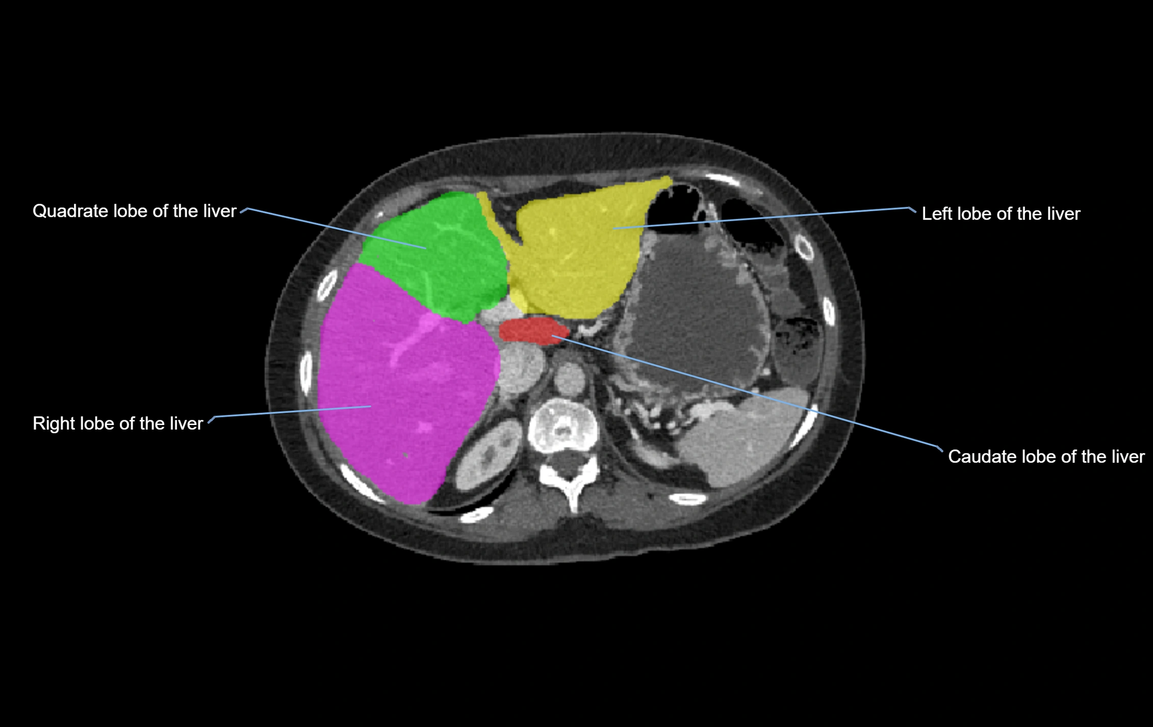 CT lliver lobes axial cross sectional anatomy labelled image -00050.webp